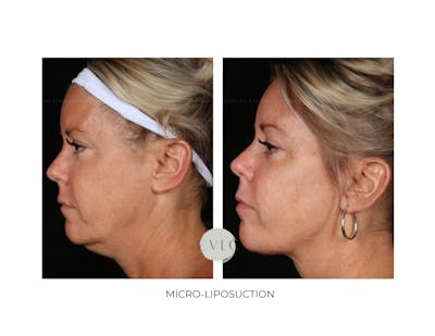 Micro-Liposuction Before & After Gallery - Patient 152894 - Image 1