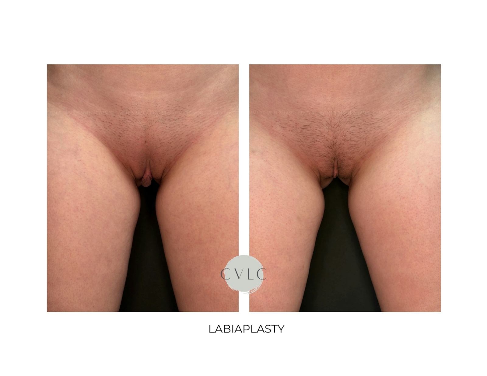 Labiaplasty Before & After Gallery - Patient 178560 - Image 1