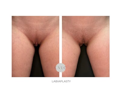 Labiaplasty Before & After Gallery - Patient 178560 - Image 1