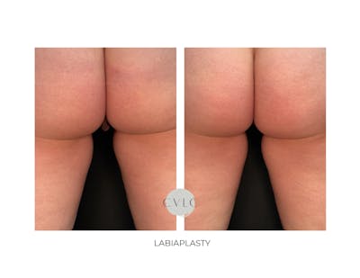 Labiaplasty Before & After Gallery - Patient 358393 - Image 1