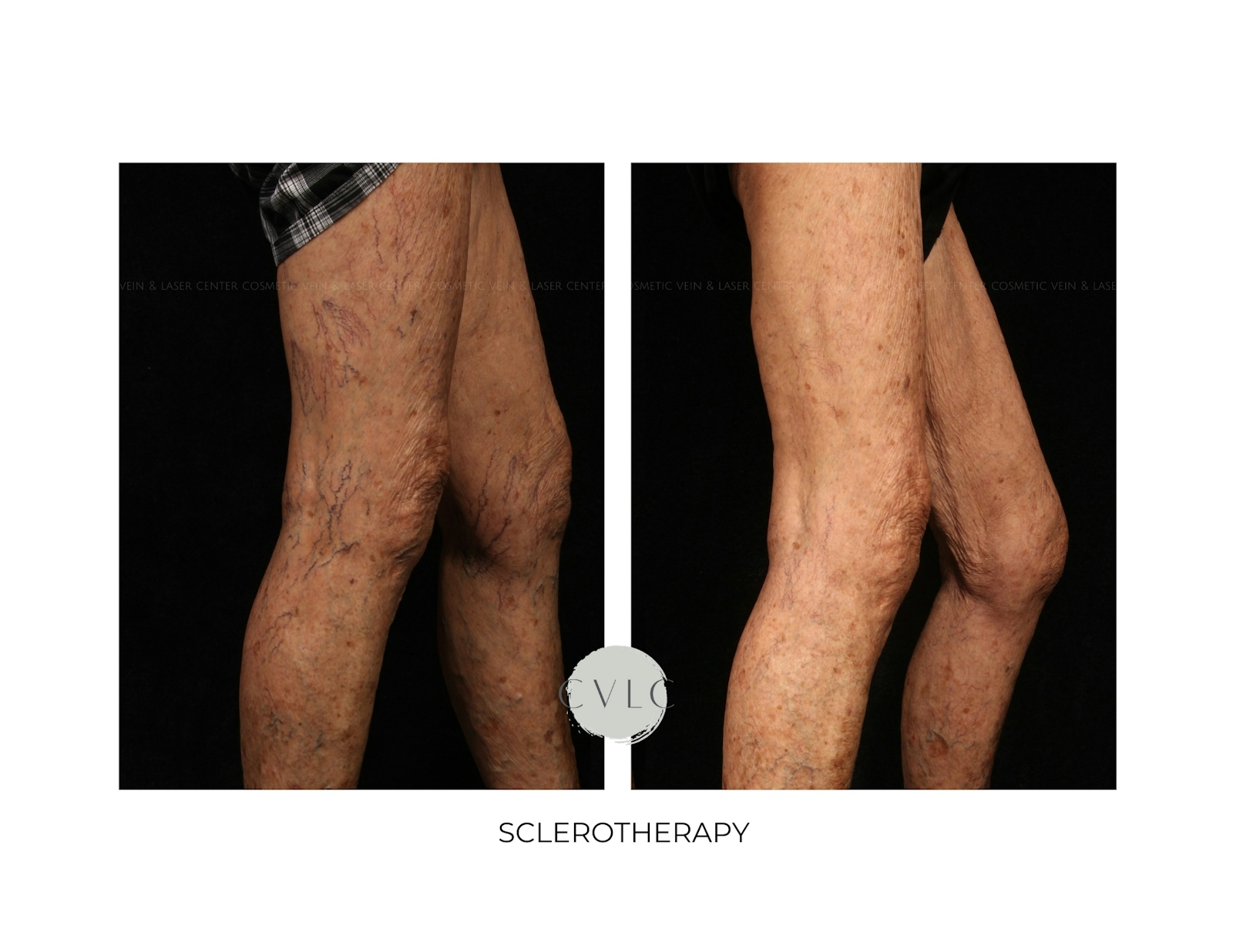 Spider Vein Treatment Before & After Gallery - Patient 185511 - Image 1