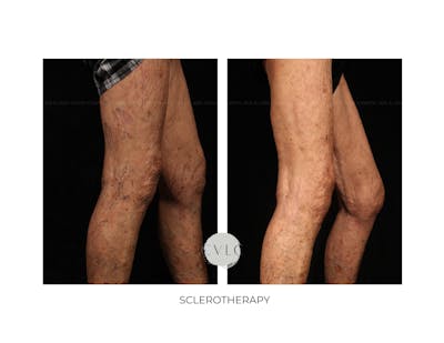 Spider Vein Treatment Before & After Gallery - Patient 185511 - Image 1