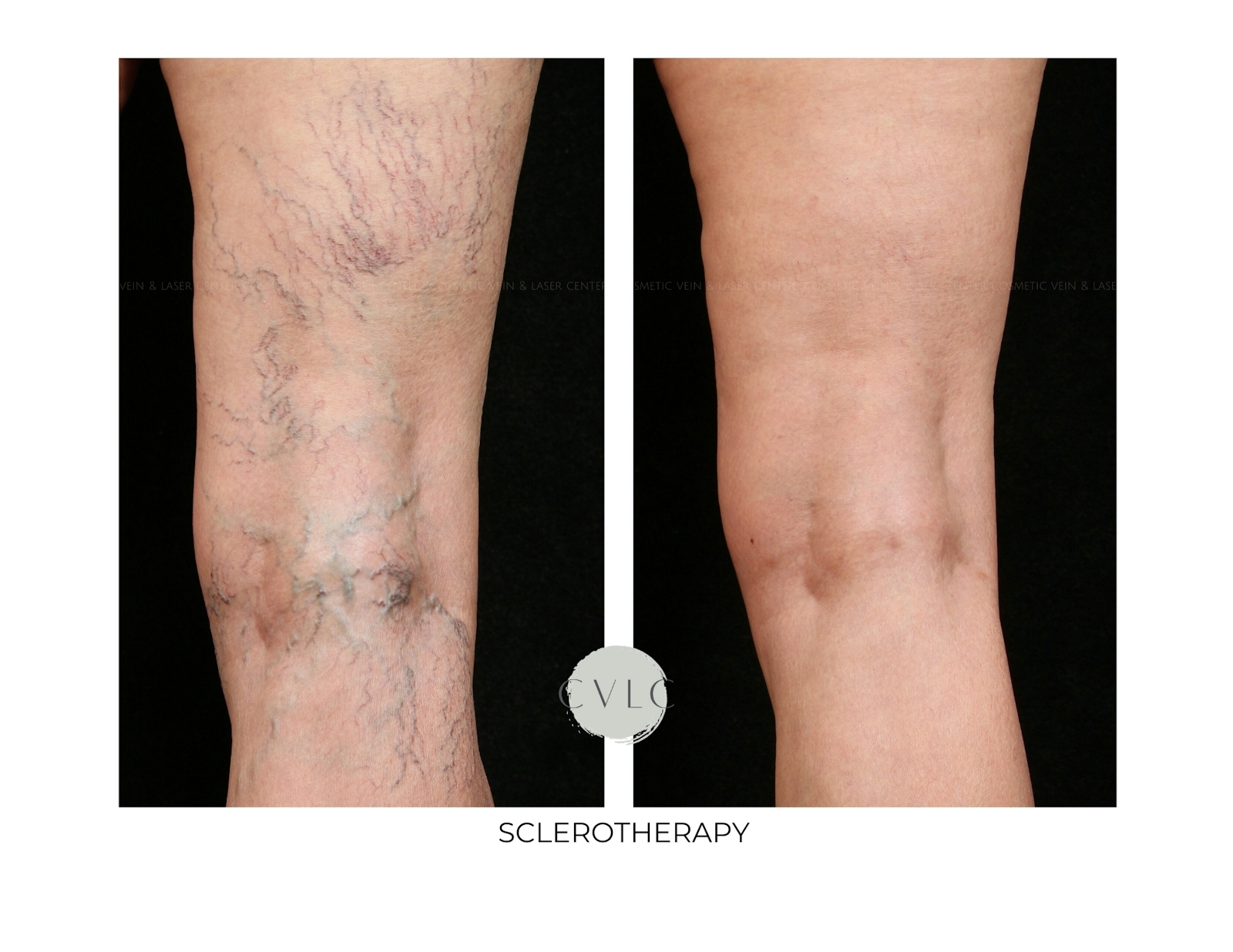 Spider Vein Treatment Before & After Gallery - Patient 141883 - Image 1