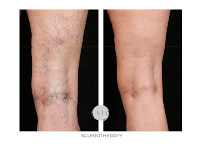 Spider Vein Treatment Before & After Gallery - Patient 141883 - Image 1