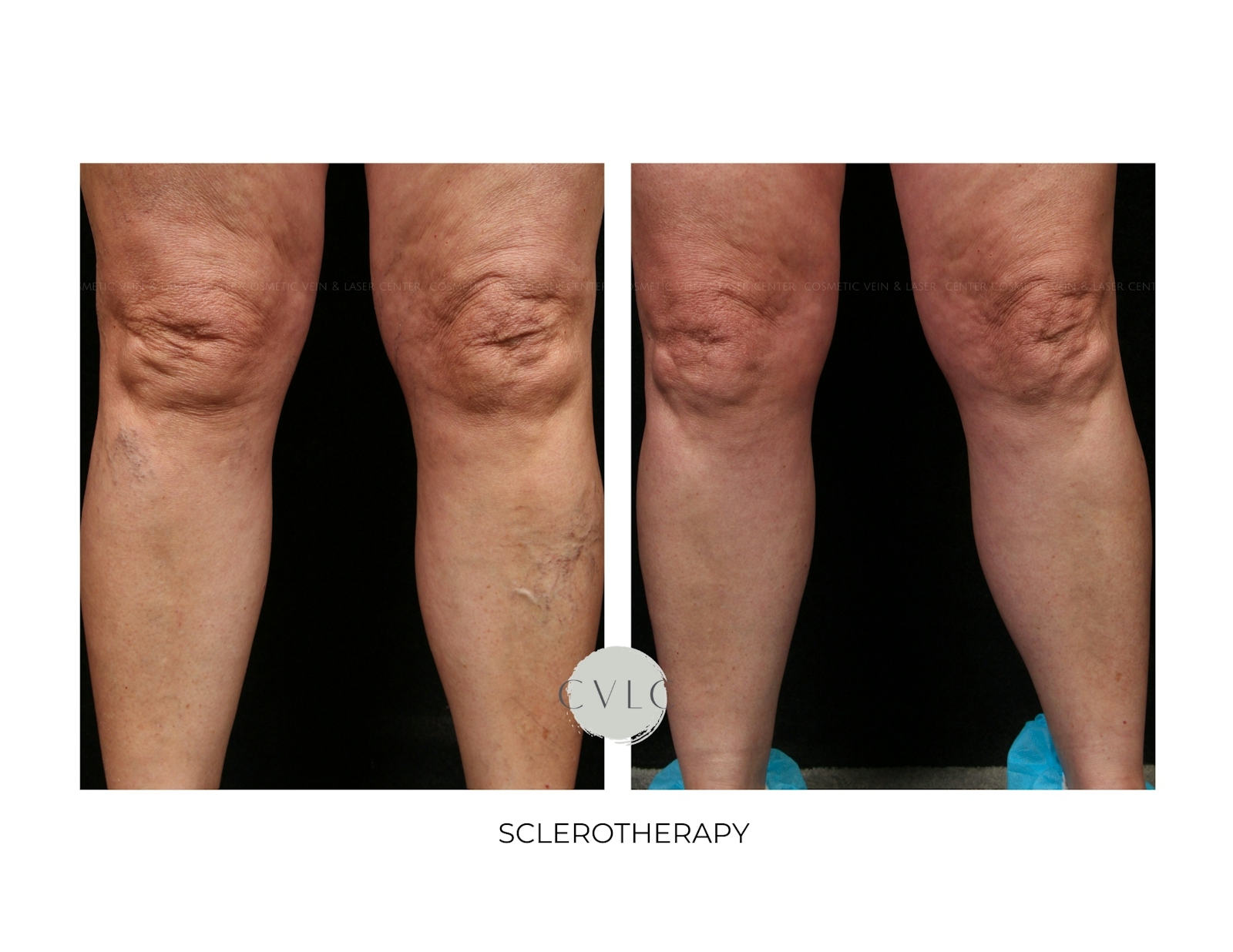 Spider Vein Treatment Before & After Gallery - Patient 466118 - Image 1