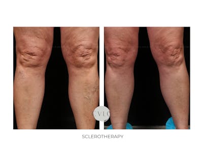 Spider Vein Treatment Before & After Gallery - Patient 466118 - Image 1