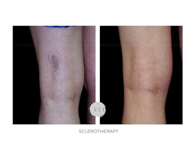 Spider Vein Treatment Before & After Gallery - Patient 331830 - Image 1