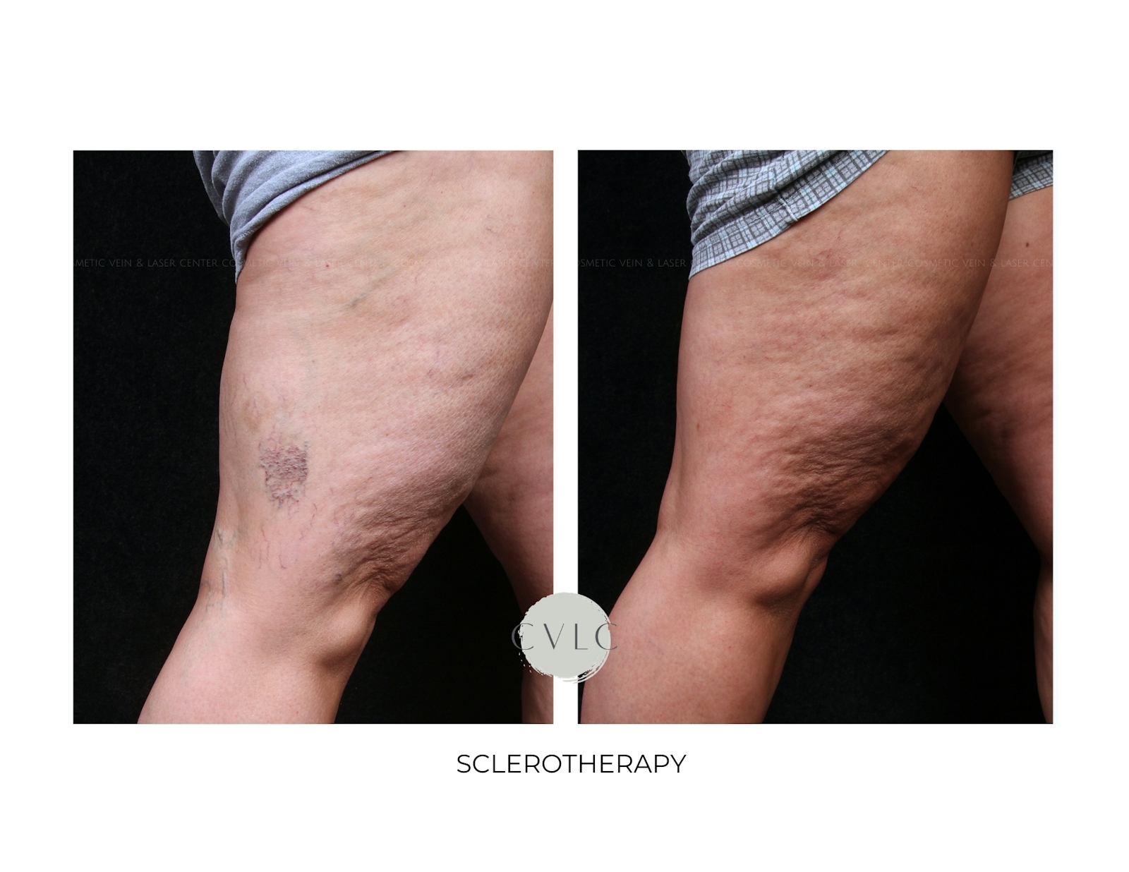 Spider Vein Treatment Before & After Gallery - Patient 195716 - Image 1