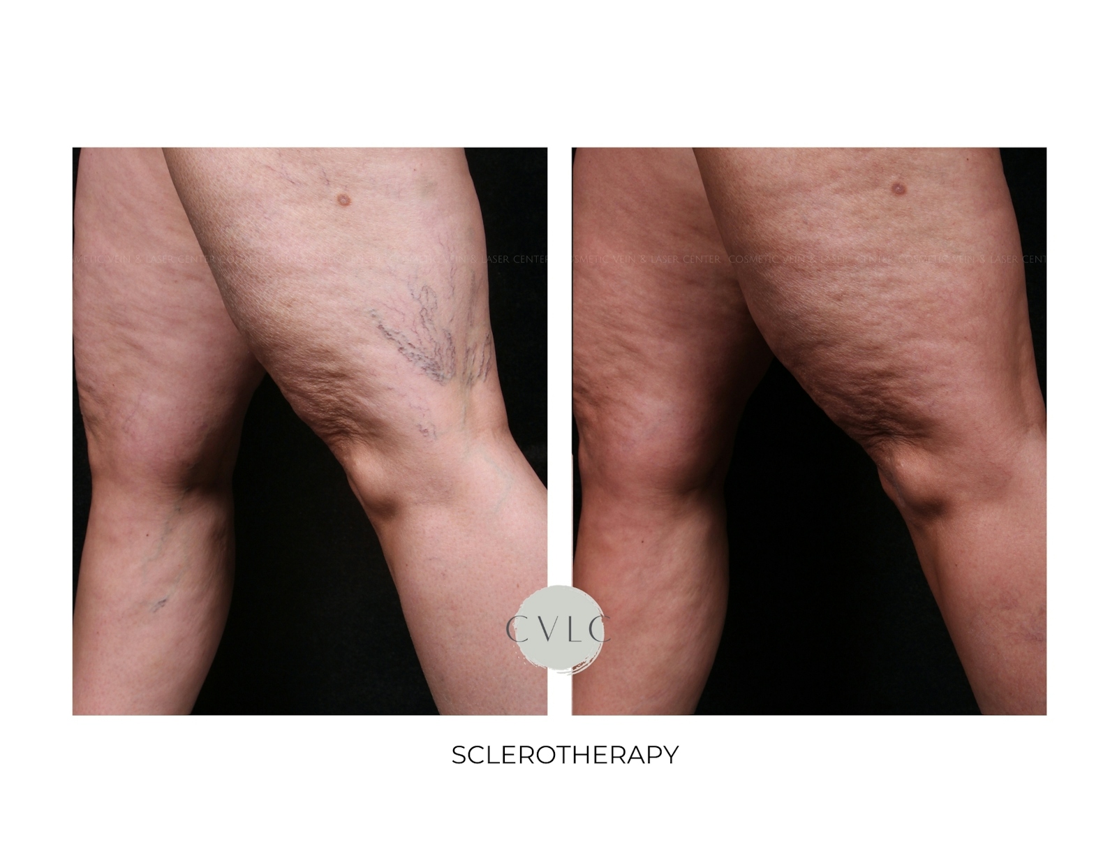 Spider Vein Treatment Before & After Gallery - Patient 182004 - Image 1