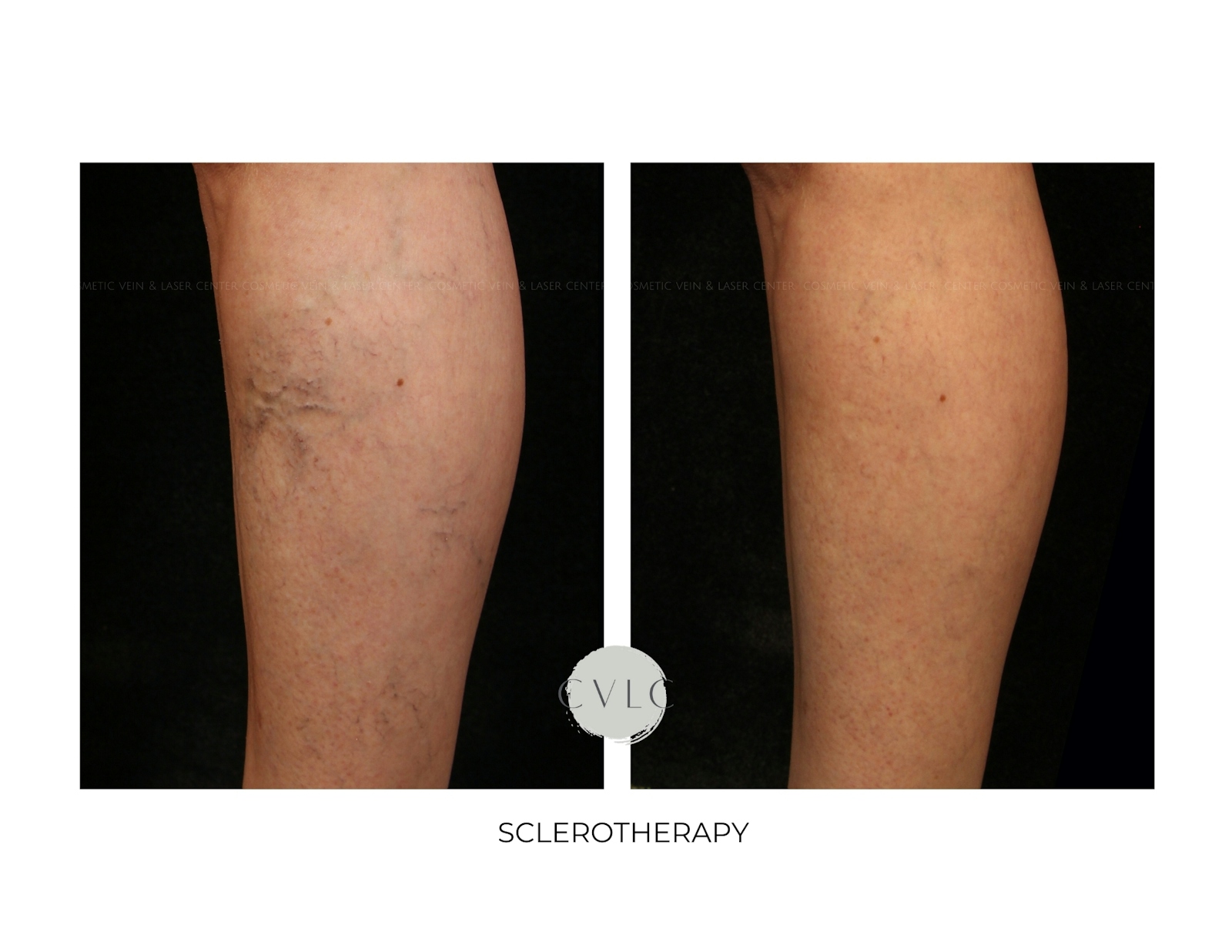 Spider Vein Treatment Before & After Gallery - Patient 326692 - Image 1