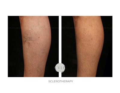 Spider Vein Treatment Before & After Gallery - Patient 326692 - Image 1