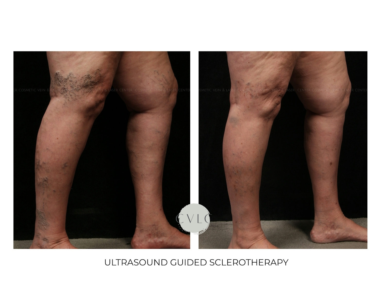Ultrasound Guided Sclerotherapy Before & After Gallery - Patient 150399 - Image 1