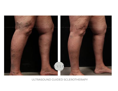 Ultrasound Guided Sclerotherapy Before & After Gallery - Patient 150399 - Image 1