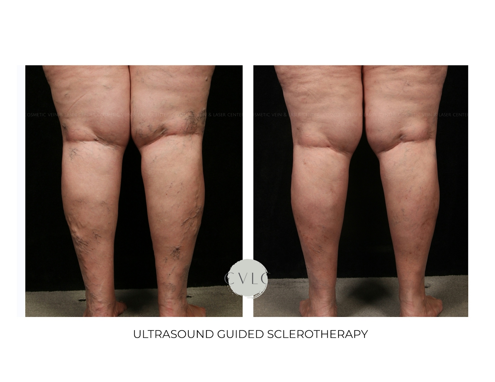 Ultrasound Guided Sclerotherapy Before & After Gallery - Patient 112971 - Image 1