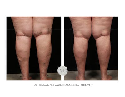 Ultrasound Guided Sclerotherapy Before & After Gallery - Patient 112971 - Image 1