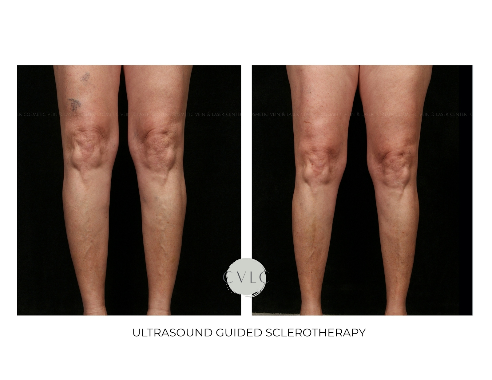 Ultrasound Guided Sclerotherapy Before & After Gallery - Patient 151195 - Image 1