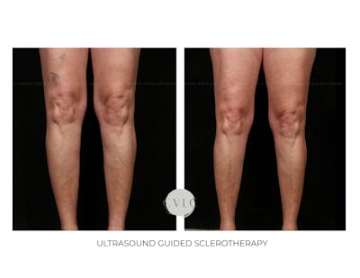 Ultrasound Guided Sclerotherapy Before & After Gallery - Patient 151195 - Image 1