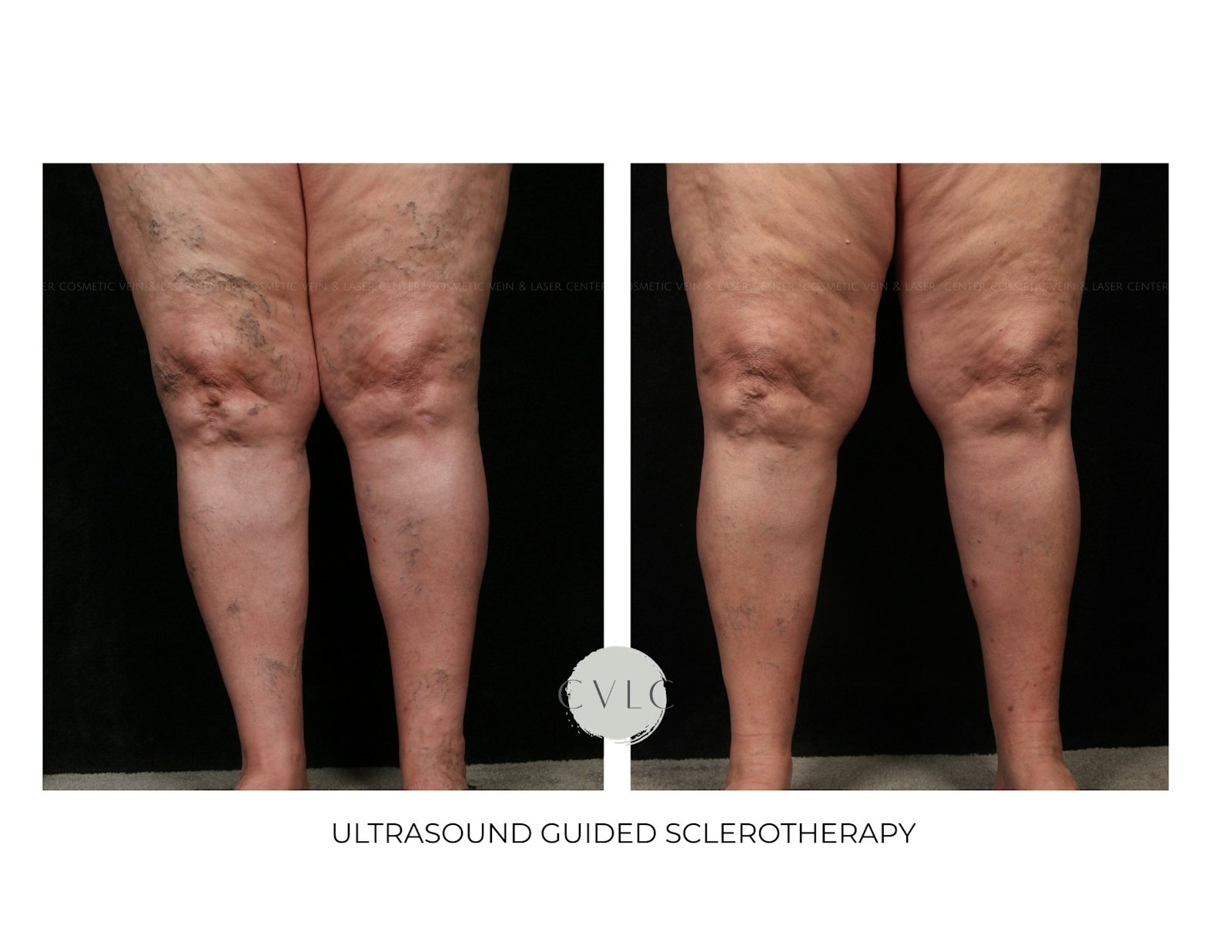 Ultrasound Guided Sclerotherapy Before & After Gallery - Patient 760126 - Image 1