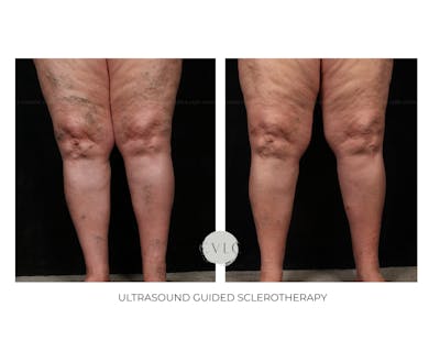 Ultrasound Guided Sclerotherapy Before & After Gallery - Patient 760126 - Image 1