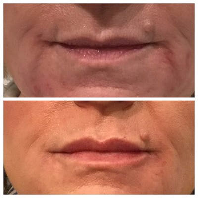 Lips Before & After Gallery - Patient 27018864 - Image 1