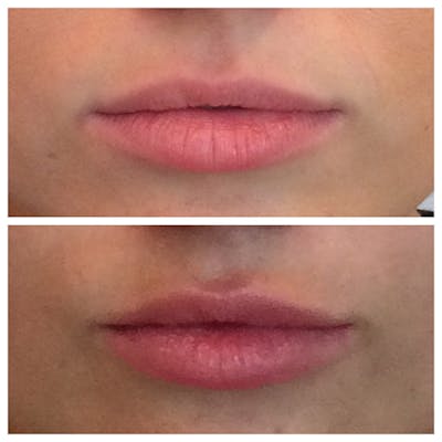 Lips Before & After Gallery - Patient 27018866 - Image 1