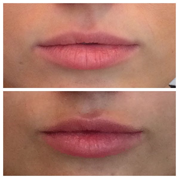 Lips Before & After Gallery - Patient 27018866 - Image 1