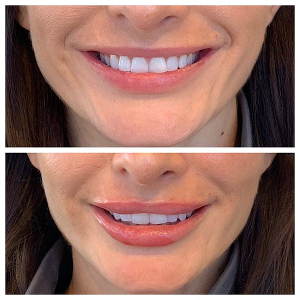 Lips Before & After Gallery - Patient 27018867 - Image 1