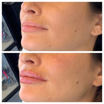 Lips Before & After Gallery - Patient 27018868 - Image 1