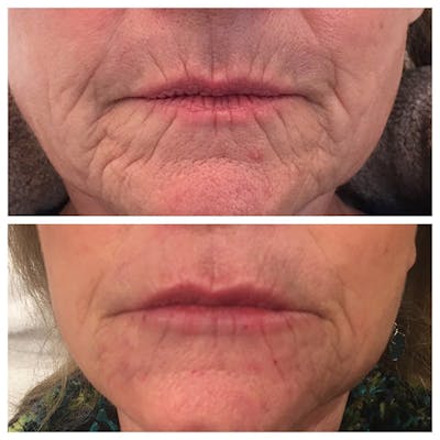 Lips Before & After Gallery - Patient 27018870 - Image 1
