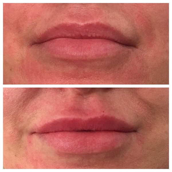 Lips Before & After Gallery - Patient 27018871 - Image 1