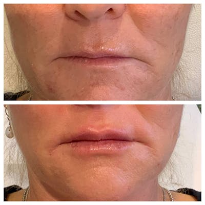 Lips Before & After Gallery - Patient 27018873 - Image 1