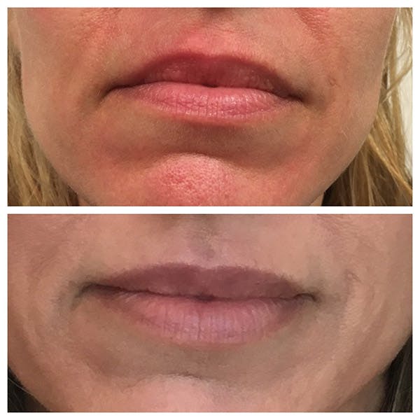 Lips Before & After Gallery - Patient 27018874 - Image 1