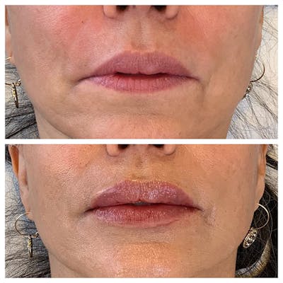 Lips Before & After Gallery - Patient 27018878 - Image 1