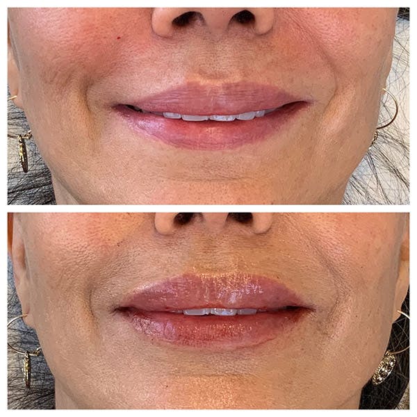 Lips Before & After Gallery - Patient 27018878 - Image 2