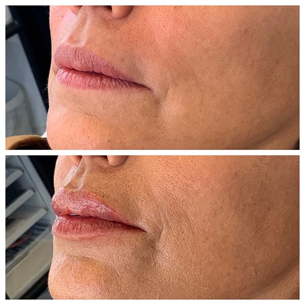 Lips Before & After Gallery - Patient 27018878 - Image 3