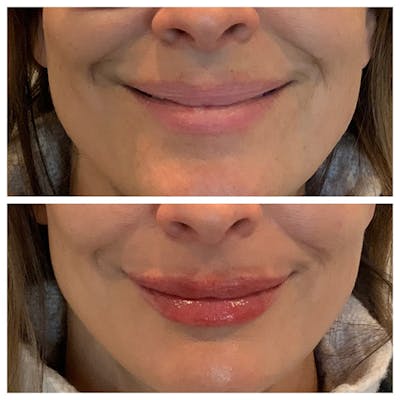 Lips Before & After Gallery - Patient 27018879 - Image 1