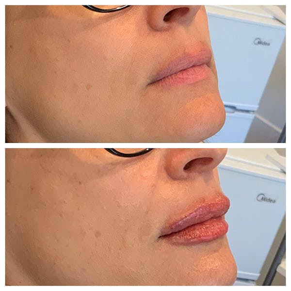 Lips Before & After Gallery - Patient 27018880 - Image 1