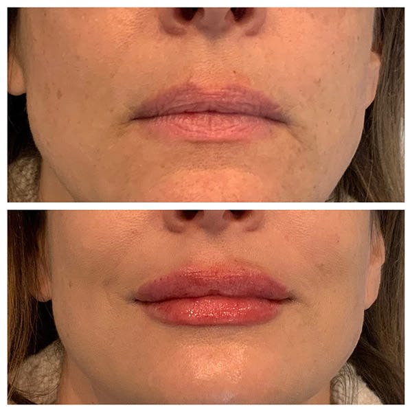 Lips Before & After Gallery - Patient 27018883 - Image 1