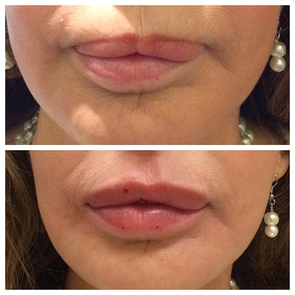 Lips Before & After Gallery - Patient 27018884 - Image 1
