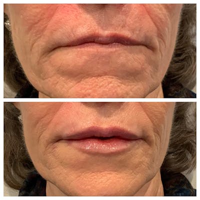 Lips Before & After Gallery - Patient 27018890 - Image 1