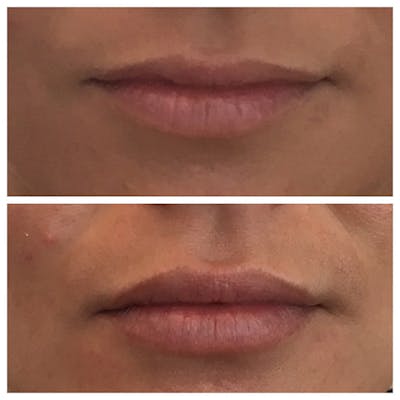 Lips Before & After Gallery - Patient 27018892 - Image 1
