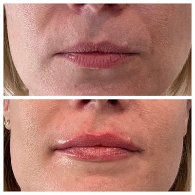 Lips Before & After Gallery - Patient 27018894 - Image 1