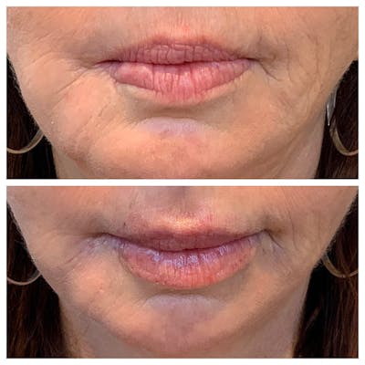 Lips Before & After Gallery - Patient 27018897 - Image 1
