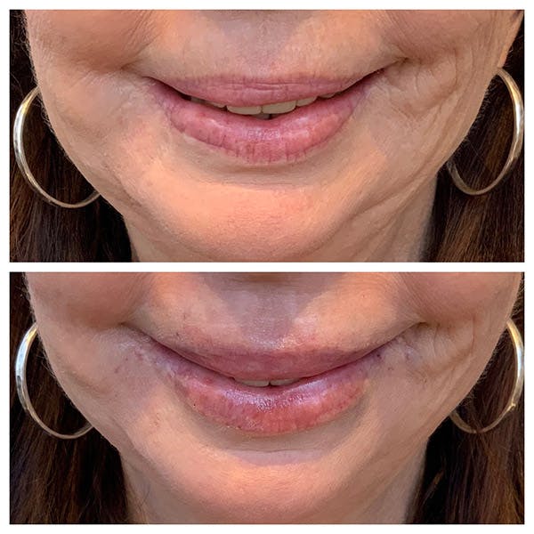 Lips Before & After Gallery - Patient 27018897 - Image 2