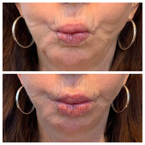 Lips Before & After Gallery - Patient 27018897 - Image 3