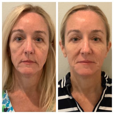 Liquid Facelift Before & After Gallery - Patient 27018898 - Image 1