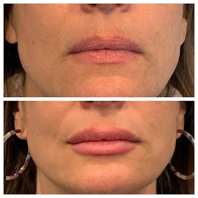 Lips Before & After Gallery - Patient 27018901 - Image 1