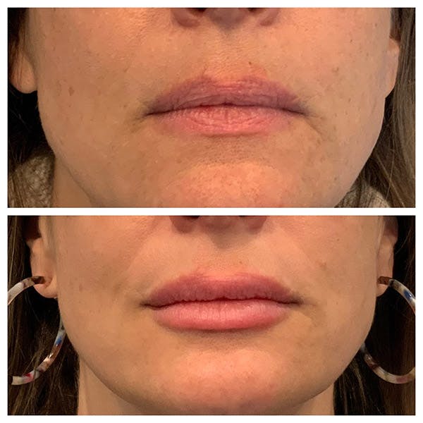 Lips Before & After Gallery - Patient 27018901 - Image 1