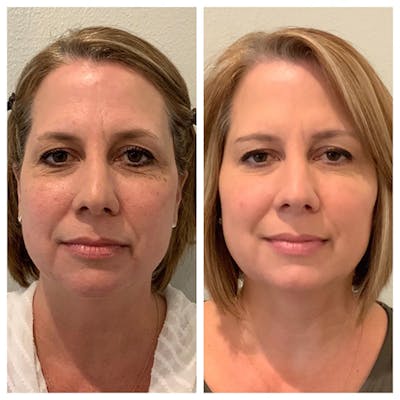 Liquid Facelift Before & After Gallery - Patient 27018899 - Image 1