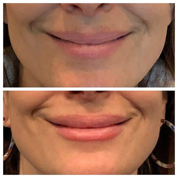 Lips Before & After Gallery - Patient 27018901 - Image 2